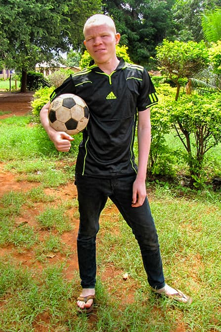 Albinism in Tanzania