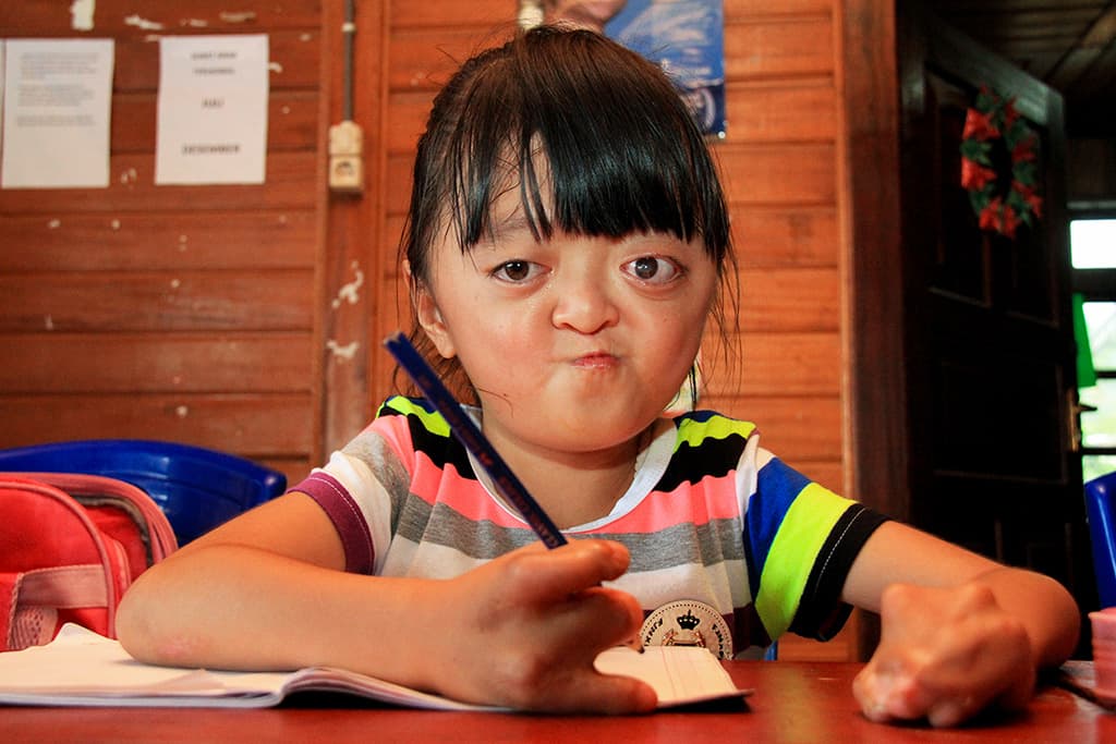 Karunia with apert syndrome